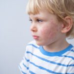 Atopowe zapalenie skóry u dzieci – przyczyny, objawy i leczenie